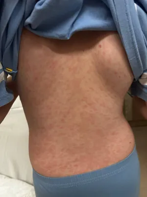 Минимум семь российских детей заболели корью в интернациональной школе на Бали