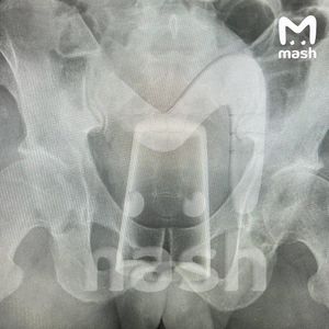 Стеклянный стакан оказался внутри жителя Уфы после посиделок 23 февраля с другом