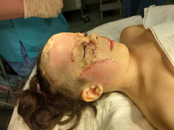 "Девочке Бэтмену" сняли швы и повязки после третьей пластической операции