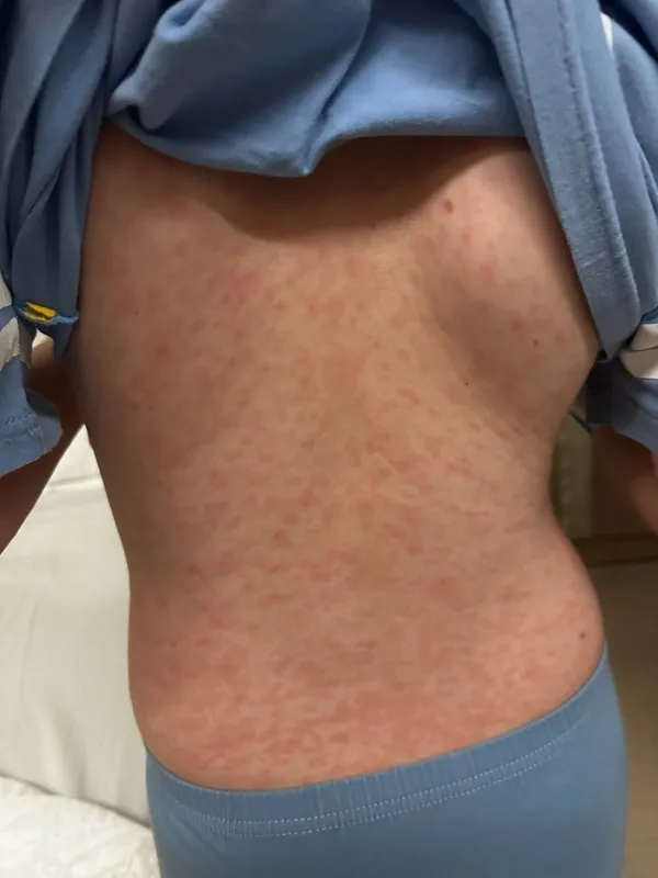 Минимум семь российских детей заболели корью в интернациональной школе на Бали