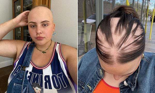 Учёные предупредили о риске облысеть после коронавируса