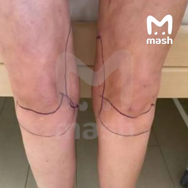 Жительнице Краснодара грозит ампутация ног после безобидной липосакции ягодиц