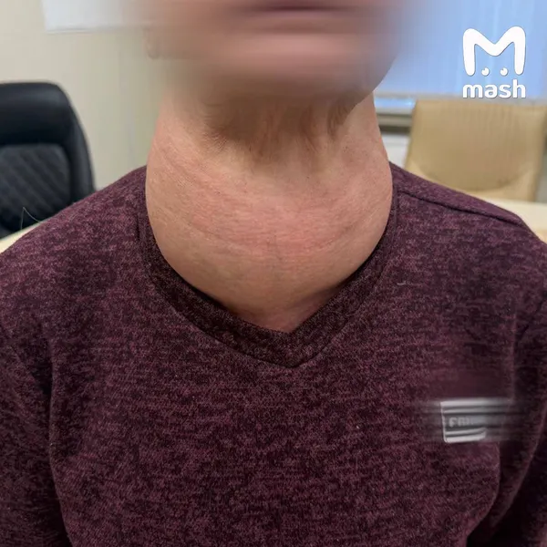 У пенсионерки в Татарстане выросла опухоль щитовидки размером с голову