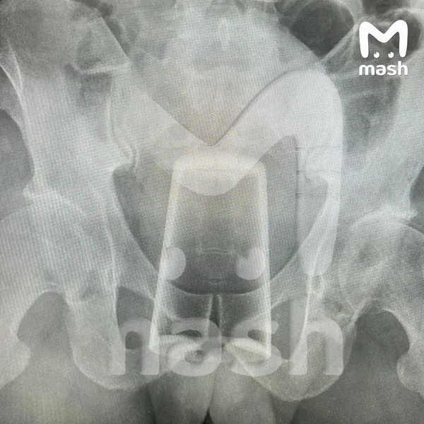 Стеклянный стакан оказался внутри жителя Уфы после посиделок 23 февраля с другом