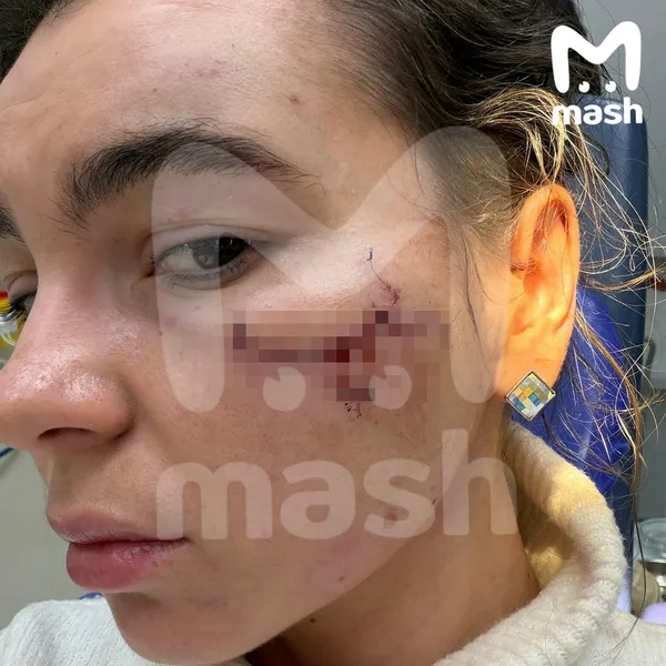 Победительницу конкурсов красоты избили и изуродовали после концерта группы "Тату" в Казани