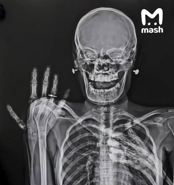 Пары россиян-медиков стали делать рентген с обручальным кольцом и запустили новый тренд