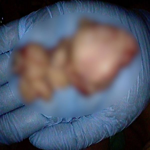 В Бурятии у мужчины достали из кишечника полип размером почти с ладонь