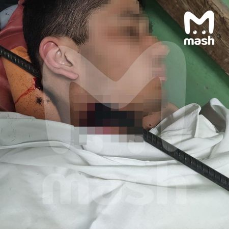 Хирурги пушкинской больницы извлекли полутораметровую арматуру из шеи мужчины