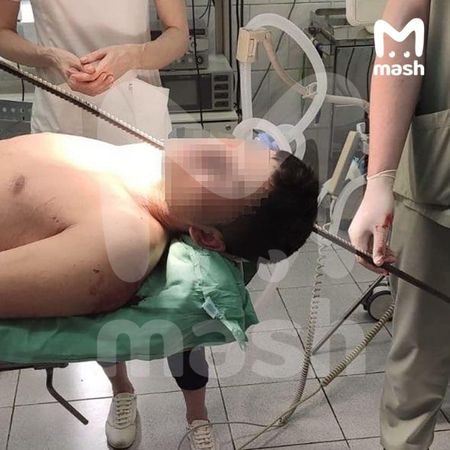 Хирурги пушкинской больницы извлекли полутораметровую арматуру из шеи мужчины