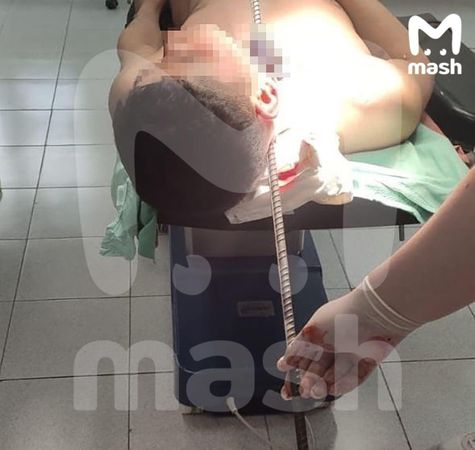 Хирурги пушкинской больницы извлекли полутораметровую арматуру из шеи мужчины