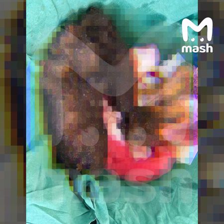 Врачи удалили из желудка девушки в Подмосковье трёхкилограммовый комок волос