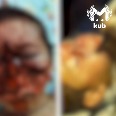 Краснодарские хирурги провели уникальную операцию мальчику, чье лицо откусила собака в Карачаево-Черкесии