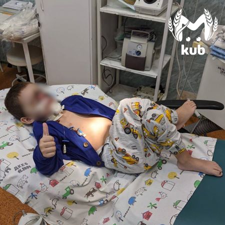 Краснодарские хирурги провели уникальную операцию мальчику, чье лицо откусила собака в Карачаево-Черкесии