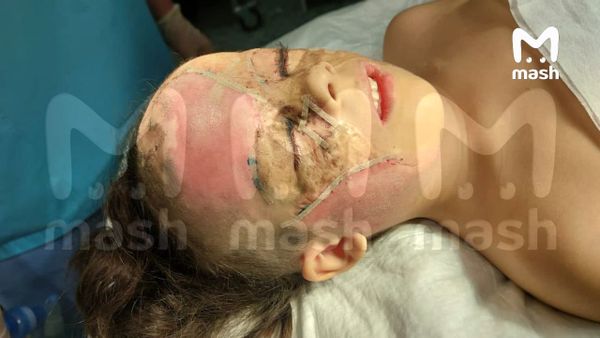 "Девочке Бэтмену" сняли швы и повязки после третьей пластической операции