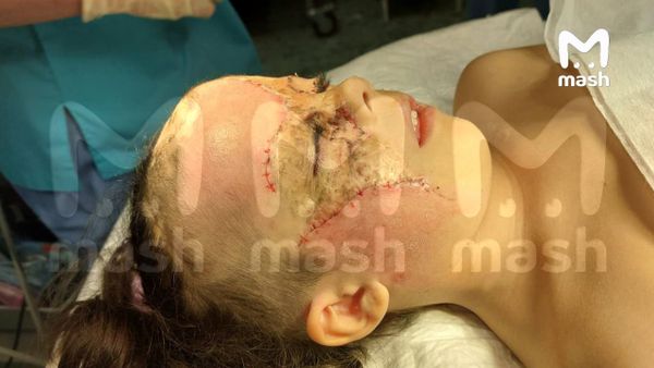 "Девочке Бэтмену" сняли швы и повязки после третьей пластической операции