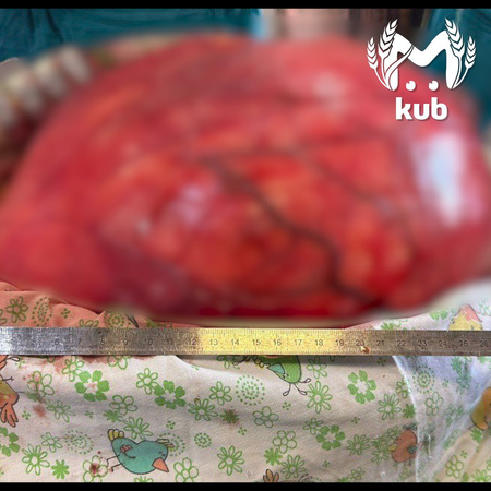 Краснодарские врачи удалили из живота пациента 17-килограммовую опухоль.