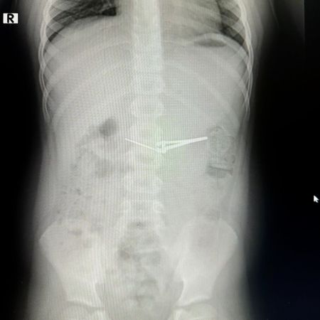 Щипцы для стрижки ногтей вытащили из желудка шестилетнего мальчика в Уфе