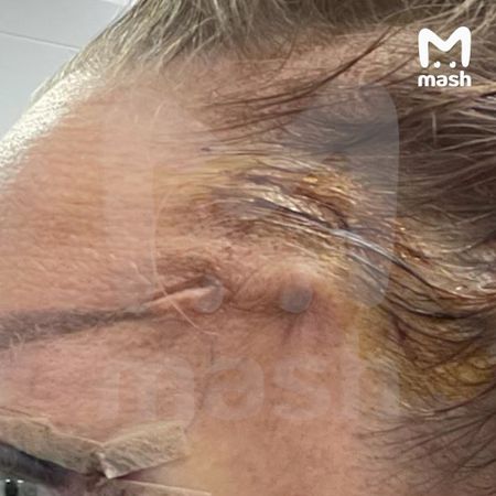 Жительнице Камчатки изуродовали лицо в звёздной клинике пластической хирургии в Москве