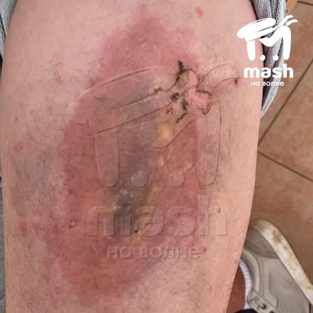 В Севастополе у мужчины в кармане взорвался телефон