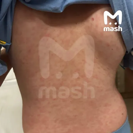 Минимум семь российских детей заболели корью в интернациональной школе на Бали