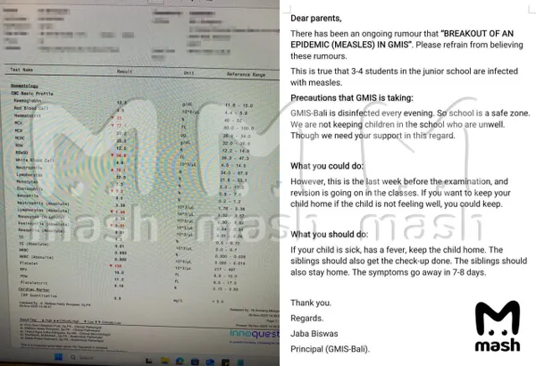 Минимум семь российских детей заболели корью в интернациональной школе на Бали