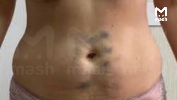 У расщепляющих жир липолитиков, продающихся на маркетплейсах, оказались опасные последствия