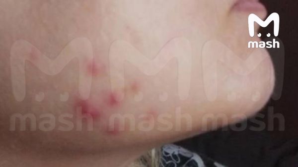 У расщепляющих жир липолитиков, продающихся на маркетплейсах, оказались опасные последствия