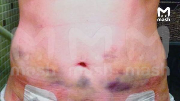 У расщепляющих жир липолитиков, продающихся на маркетплейсах, оказались опасные последствия