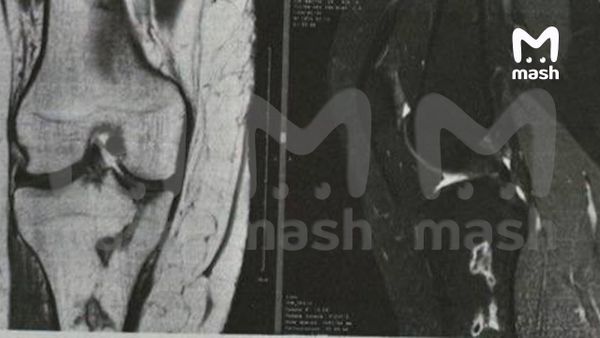 Жительнице Краснодара грозит ампутация ног после безобидной липосакции ягодиц