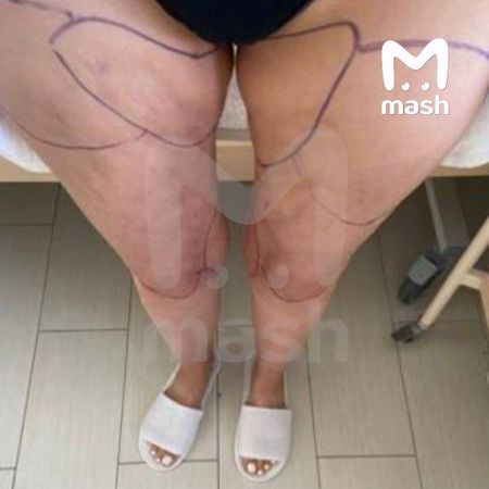 Жительнице Краснодара грозит ампутация ног после безобидной липосакции ягодиц