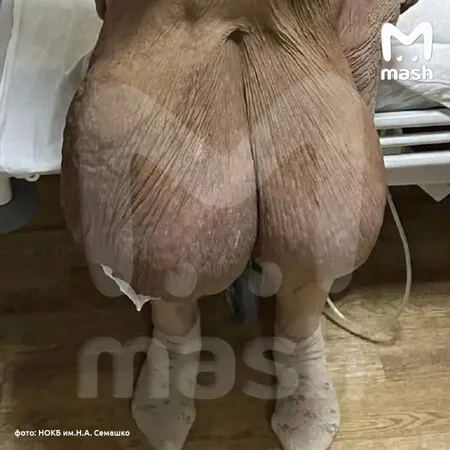 В Нижегородской области у женщины вырезали гигантское образование на животе