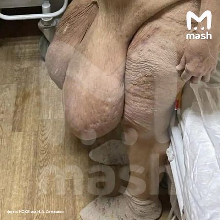 В Нижегородской области у женщины вырезали гигантское образование на животе