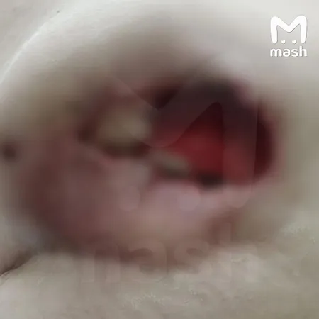 Жительница Тулы год прожила с салфеткой, которую хирург забыл в груди во время операции