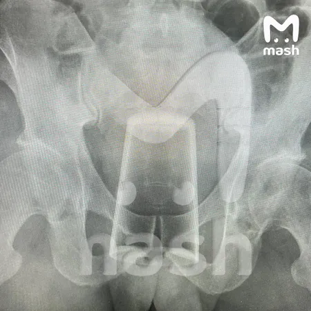 Стеклянный стакан оказался внутри жителя Уфы после посиделок 23 февраля с другом