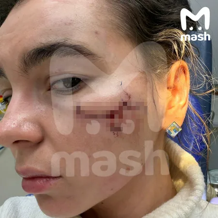 Победительницу конкурсов красоты избили и изуродовали после концерта группы "Тату" в Казани