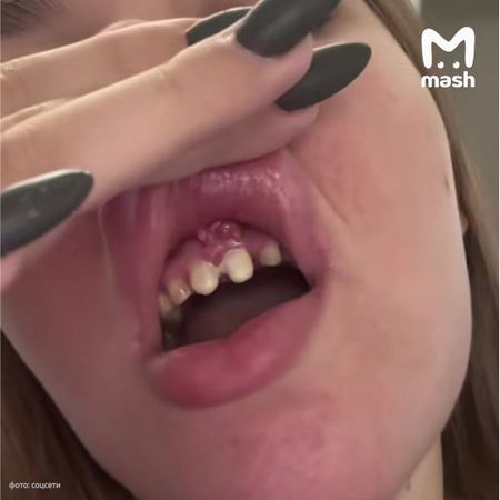 Блогерка осталась без зубов после установки виниров в частной клинике Иркутска