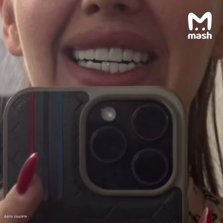 Блогерка осталась без зубов после установки виниров в частной клинике Иркутска