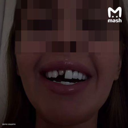 Блогерка осталась без зубов после установки виниров в частной клинике Иркутска