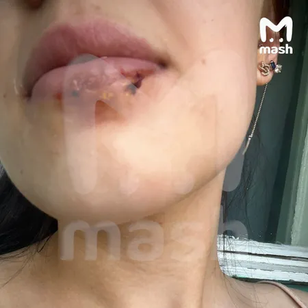 Блогер получила химический ожог из-за того, что открыла мороженое зубами