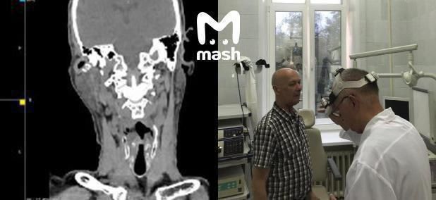 Московские врачи спасли от рака мужчину, пережившего пересадку сердца ЧЕТЫРЕ раза.