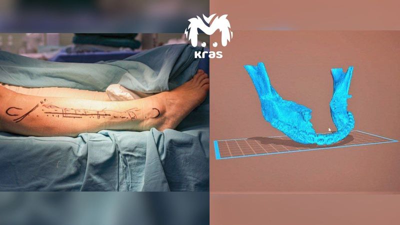 Красноярские хирурги сделали женщине новую челюсть из её ноги