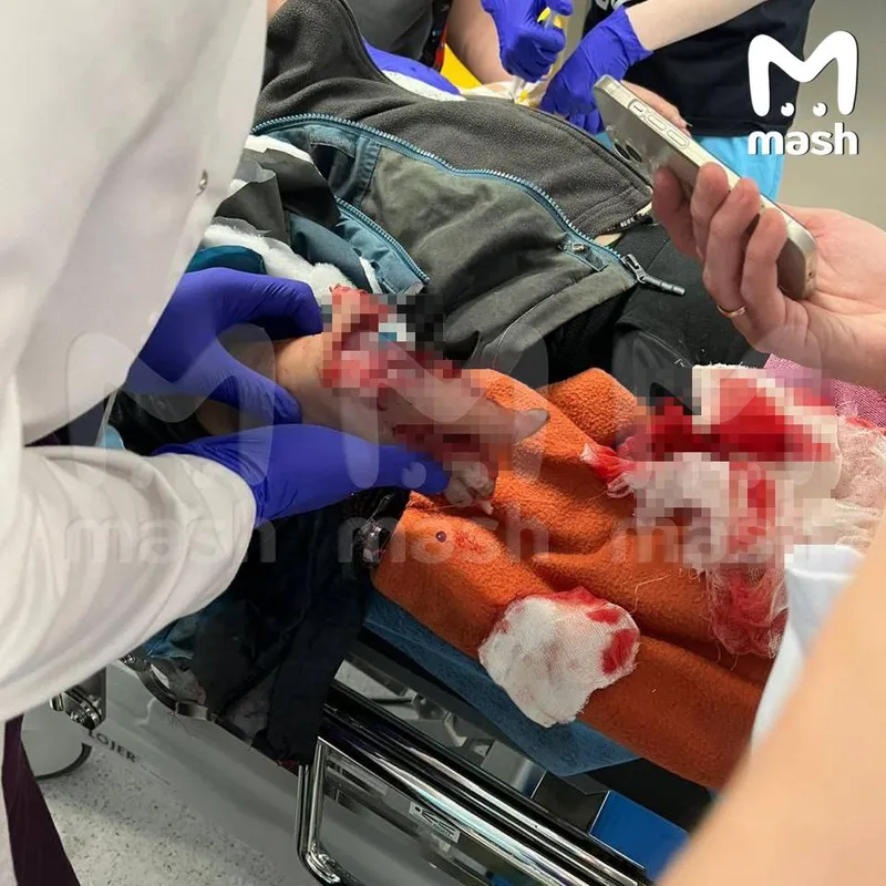 В Красногорске мальчику оторвало пальцы при взрыве: что произошло, фото, видео с места