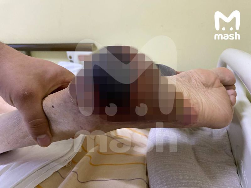 В домах Обнинска Калужской области из кранов побежал кипяток, обварились минимум 20 человек